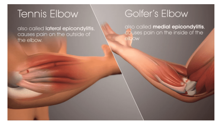 Guide to the Prevention & Treatment of Golfer’s Elbow