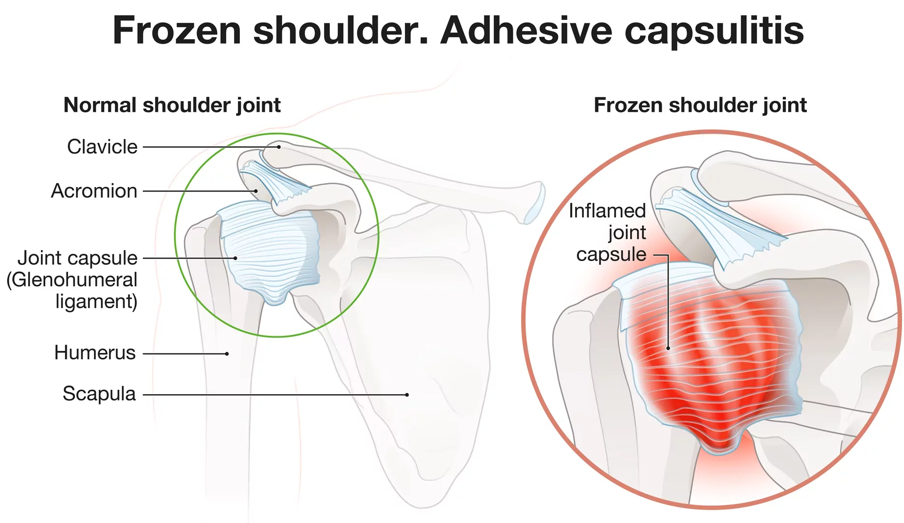 Frozen Shoulder Treatment & Rehabilitation