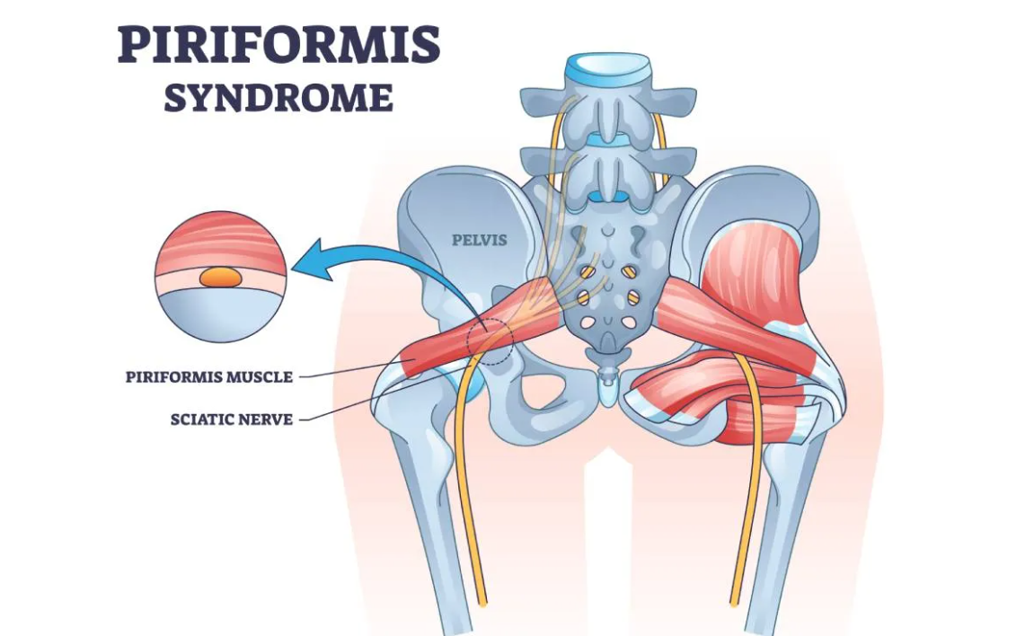 Visual representation of Piriformis Syndrome