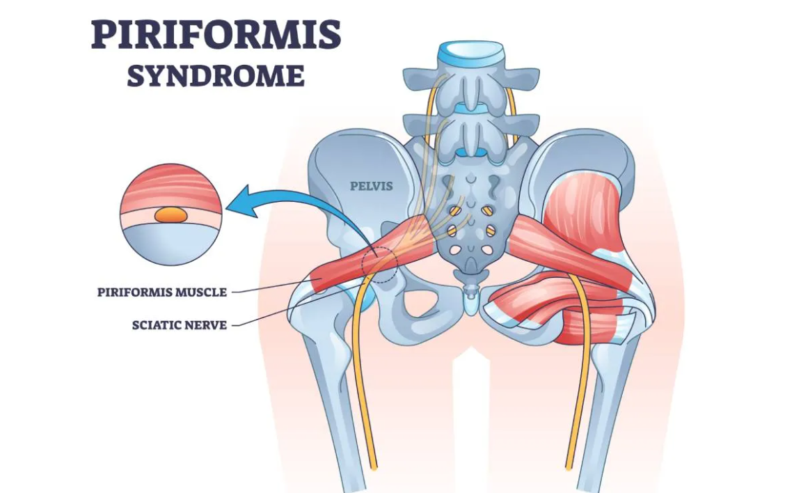 Piriformis Syndrome Exercises Stretches Understanding Training piriformis-syndrome-exercises-stretches-understanding-training