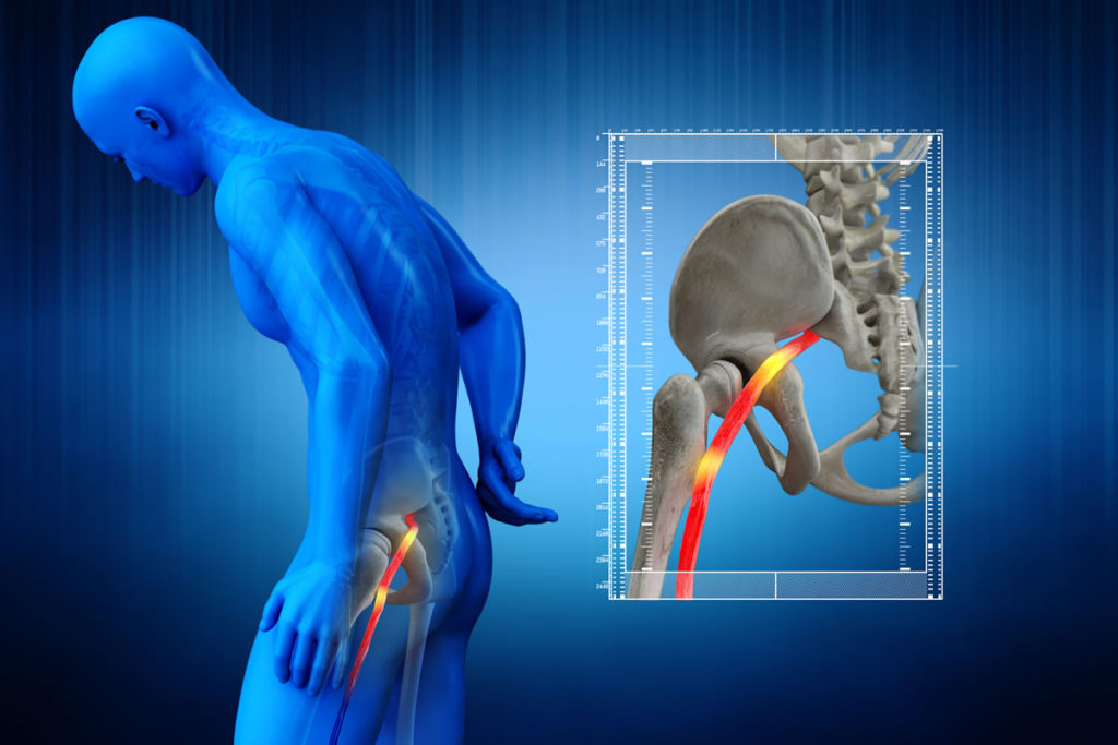 Exercise & Sciatic Pain Relief  